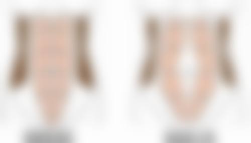 五、有骨膜贴片隆鼻吗？术后修复注意事项