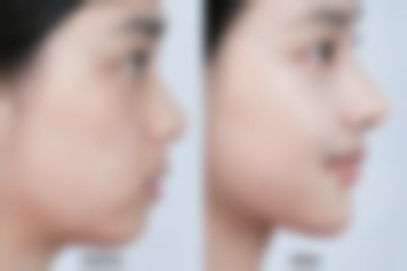 一、有骨膜贴片隆鼻吗？认识骨膜贴片隆鼻