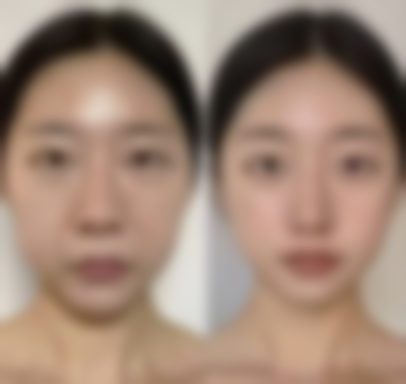 三、有骨膜贴片隆鼻吗？成效呈现