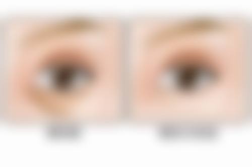 四、眼袋问题评估与解决方案