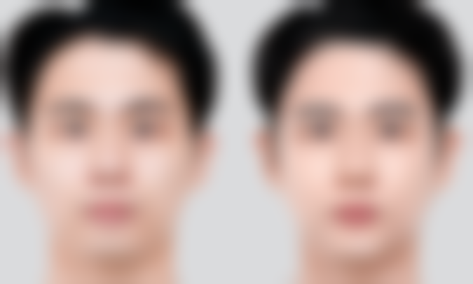 手术能去掉眼袋吗？——总结