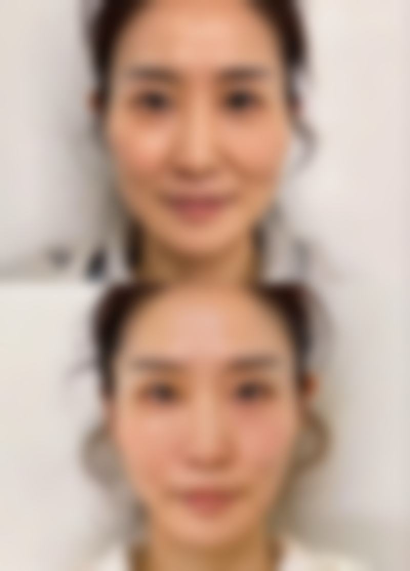 三、青春魔法棒与其他除皱方式的对比