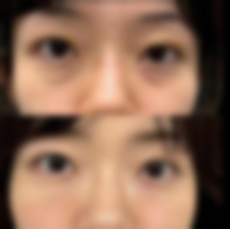 二、影响青春魔法棒除皱成效的因素