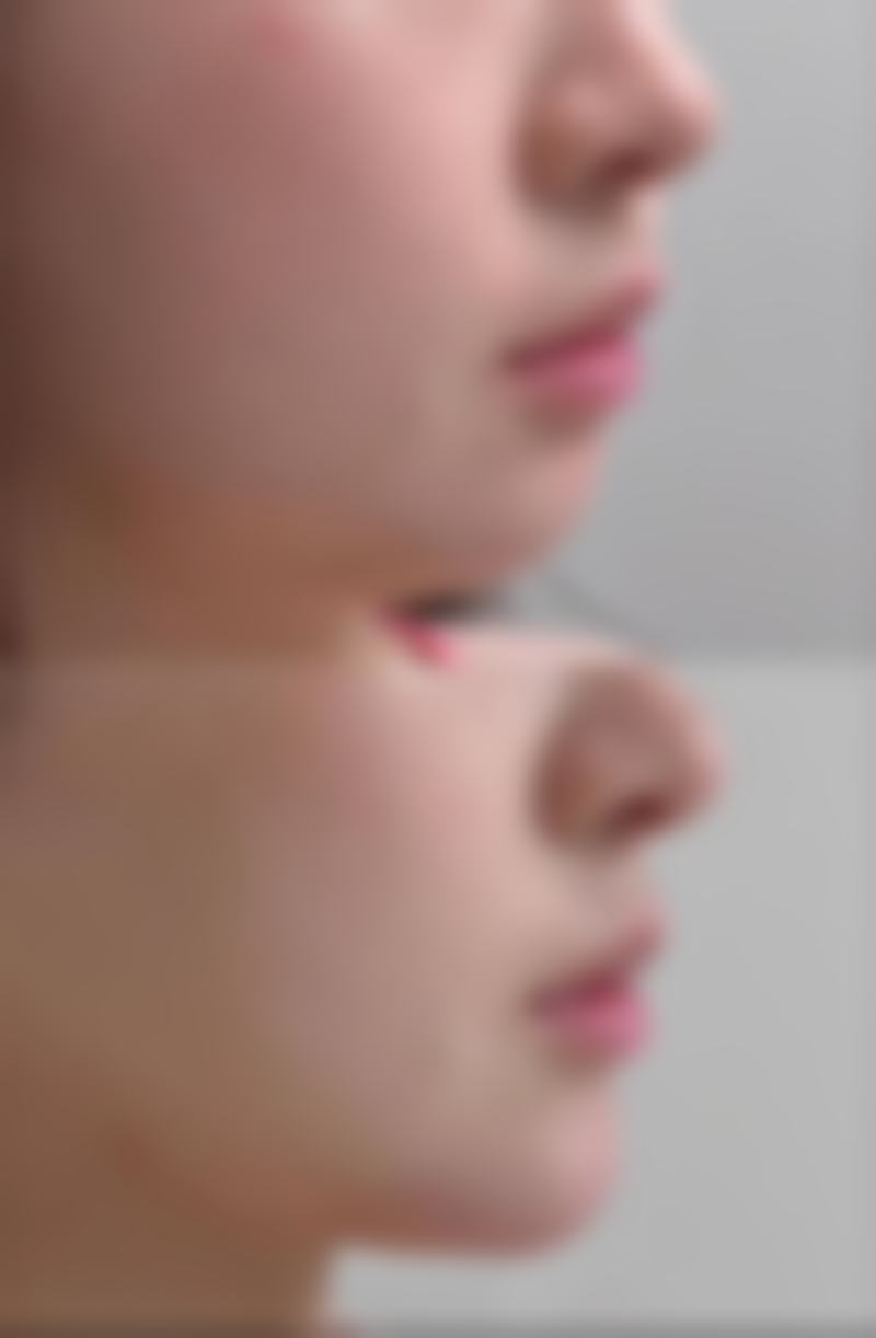 手术能去掉眼袋吗？揭秘不同术式效果、风险及去眼袋手术的大致费用 