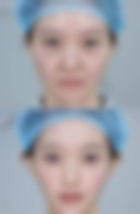 三、如何能够快速的祛眼袋之医美手段