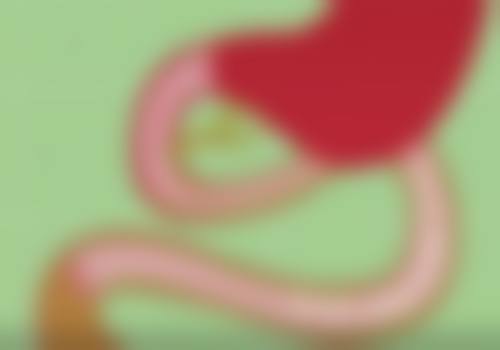 四、英捷尔法勒隆胸取出后不同阶段的修复表现