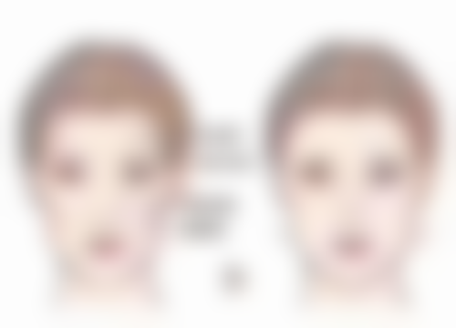 四、如何提高自体隆胸手术成效？