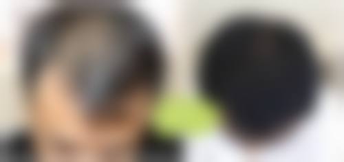 九、保定熙朵植发真实的患者评价