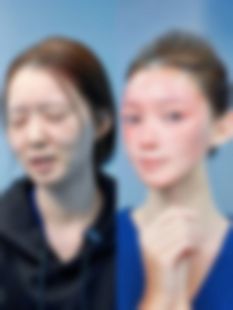 三、自体隆胸手术成效好坏的其他方面