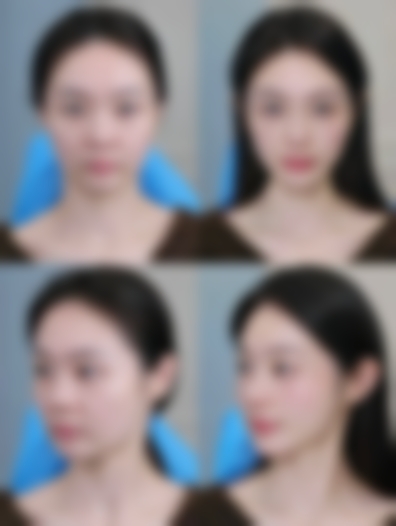 三、怎样去眼袋又快又好的小窍门之医美解决方案