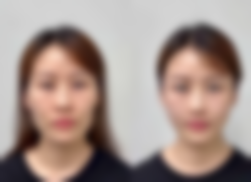 五、英捷尔法勒隆胸取出后的术后护理关键点