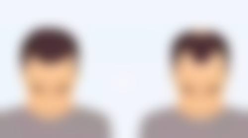 三、割双眼皮后玩手机对眼部健康的其他影响