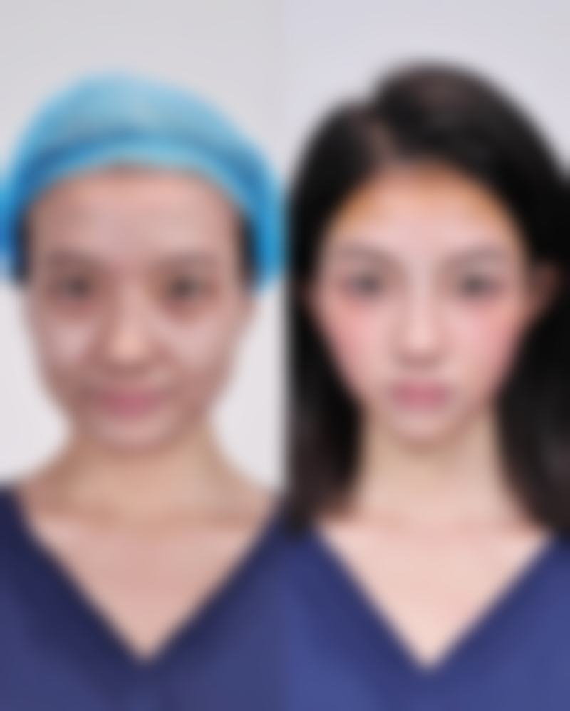 割双眼皮后经常玩手机有什么影响？一直玩或致肿胀增生、恢复延迟要警惕！ 