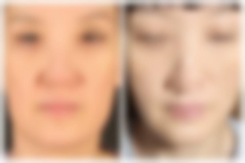 一、双眼皮多久修复期：总体时间情况