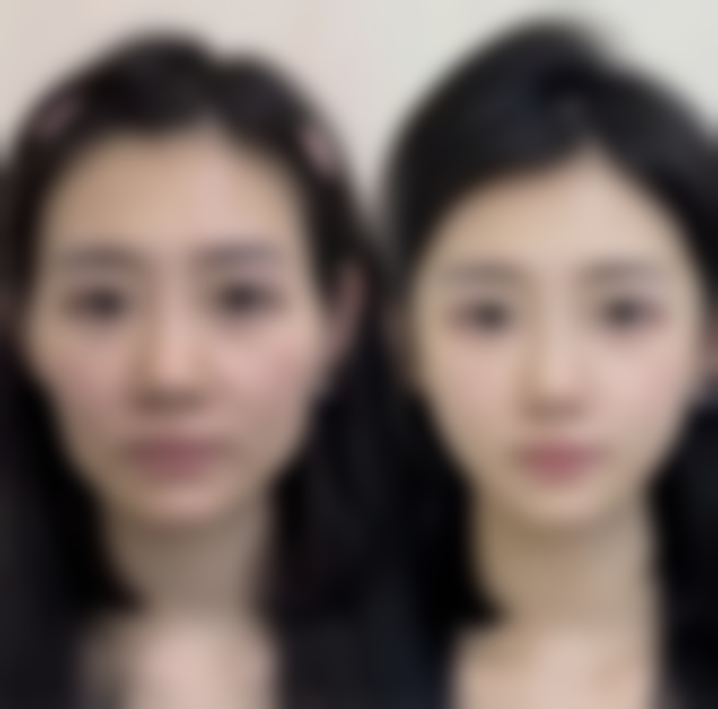 一、黑眼圈眼袋成因大揭秘