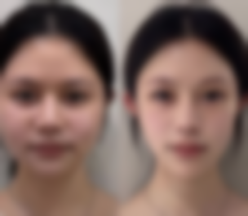 三、针灸隆鼻能维持多久——影响因素大揭秘