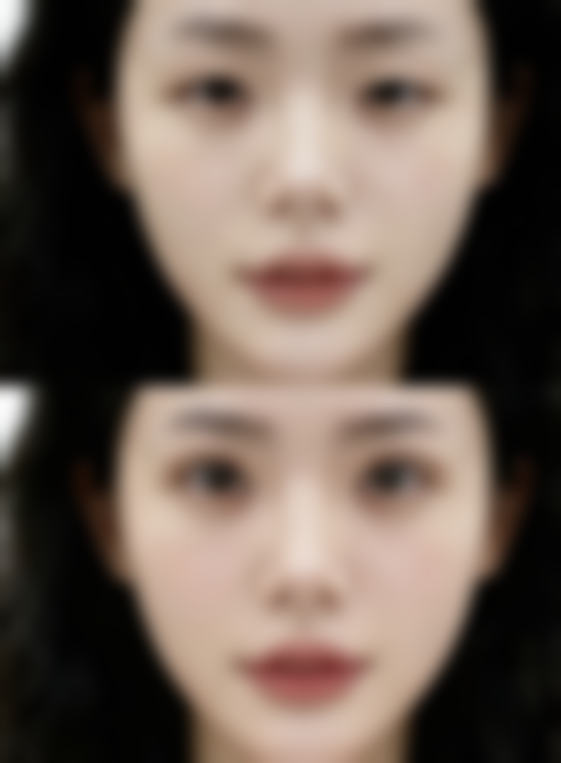 四、针灸隆鼻能维持多久——与其他隆鼻方式对比