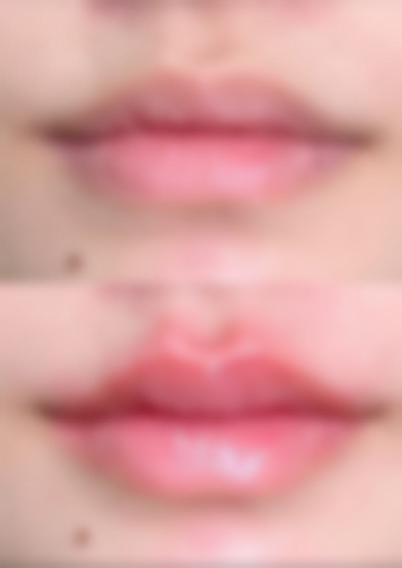 三、割双眼皮抽脂可能存在的风险