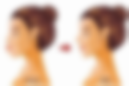 割完双眼皮能吃肉吗？合理吃肉促进恢复，正确护理还可降低留疤风险！