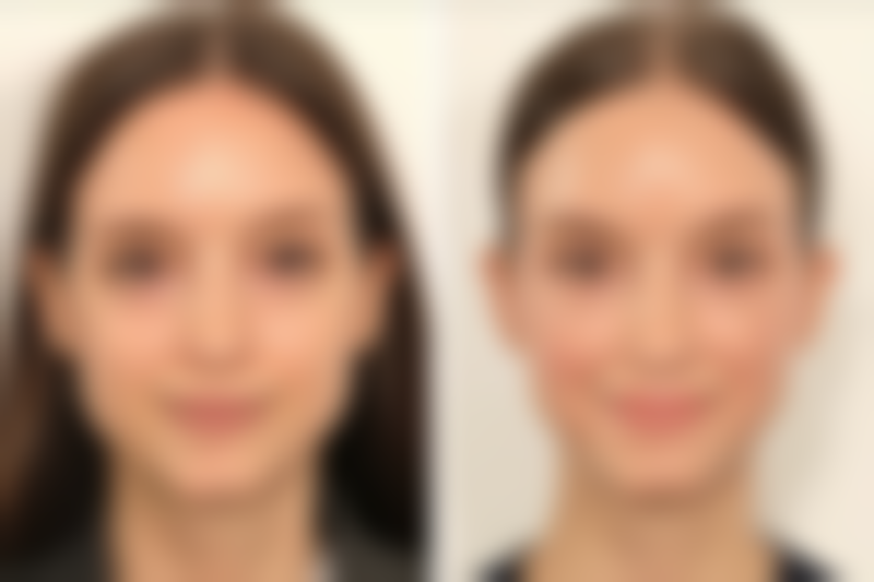 六、疤痕增生治疗的实例分享