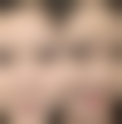 下颌角整形手术怎么做？了解手术步骤、效果与风险，附精彩视频揭秘 