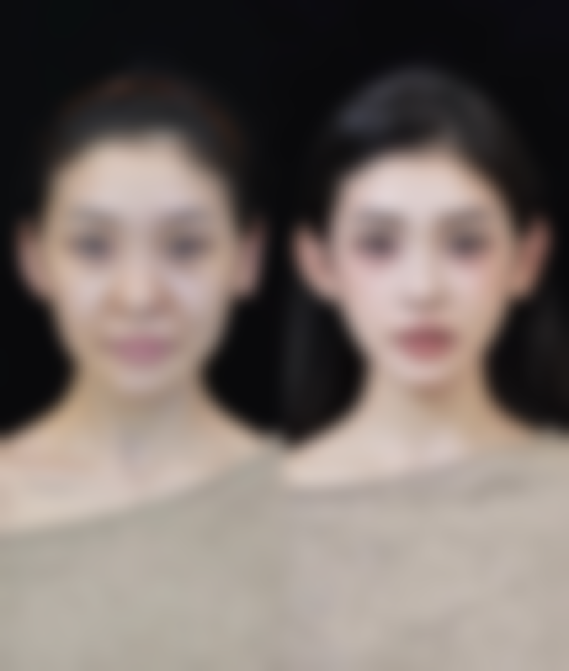 四、延长自体脂肪隆鼻成效的方法