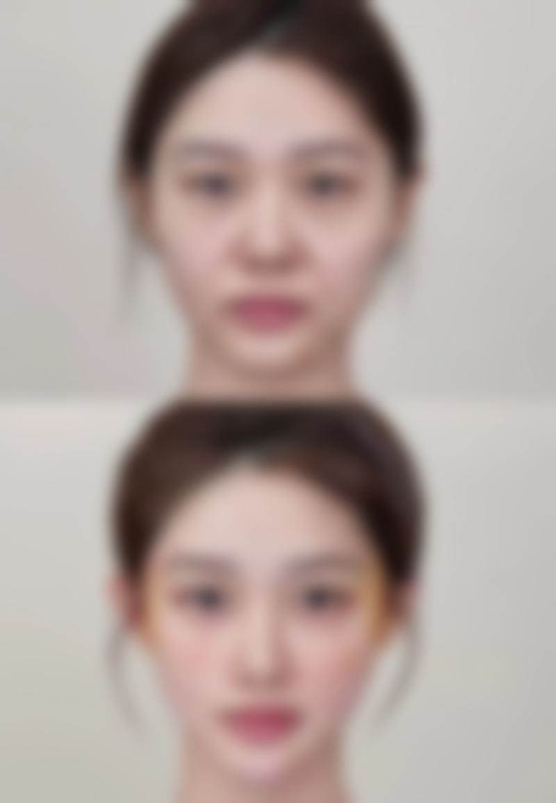 二、其他可能导致晨起眼睛浮肿眼袋大的疾病原因