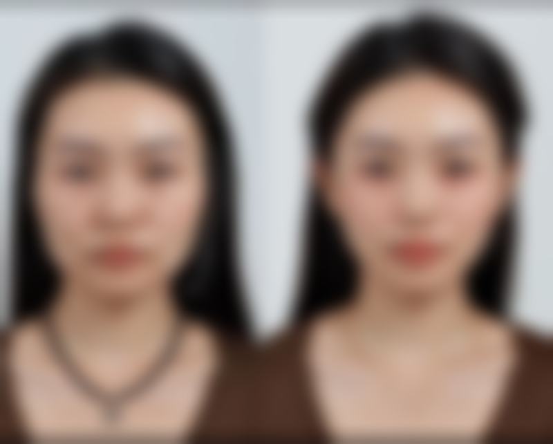 五、下颌角整形手术的成效