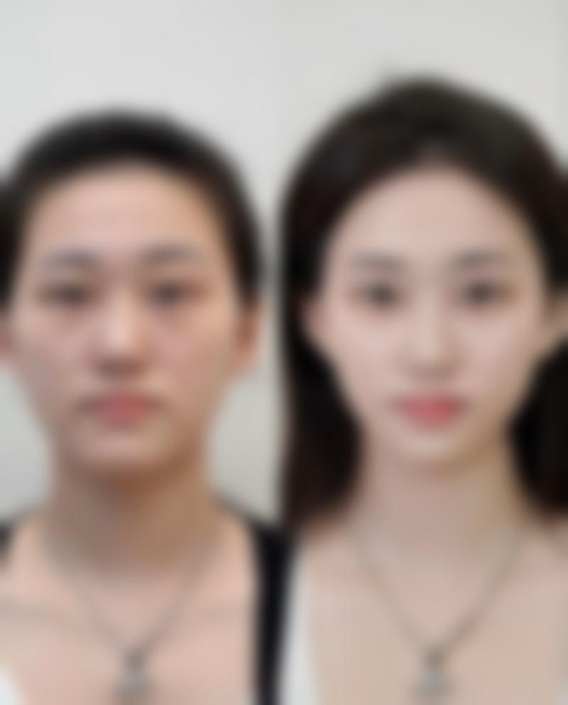 二、下颌角整形手术的方式与适应情况