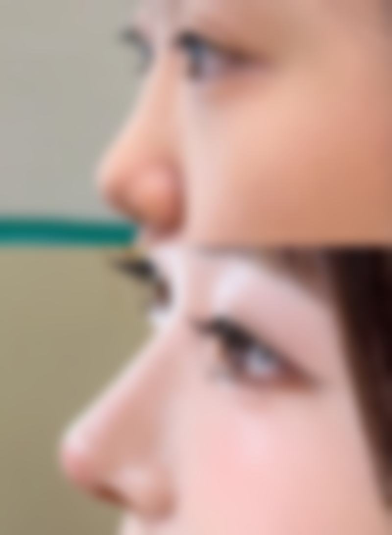 三、不同阶段疤痕增生的治疗方案选择