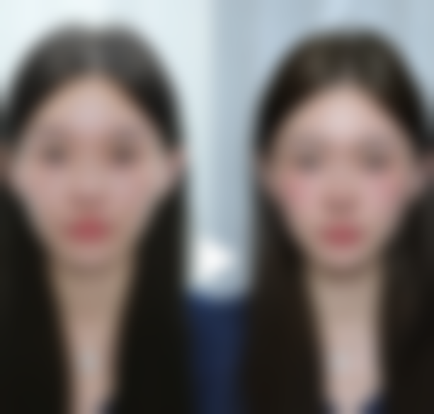 四、下颌角整形手术的步骤