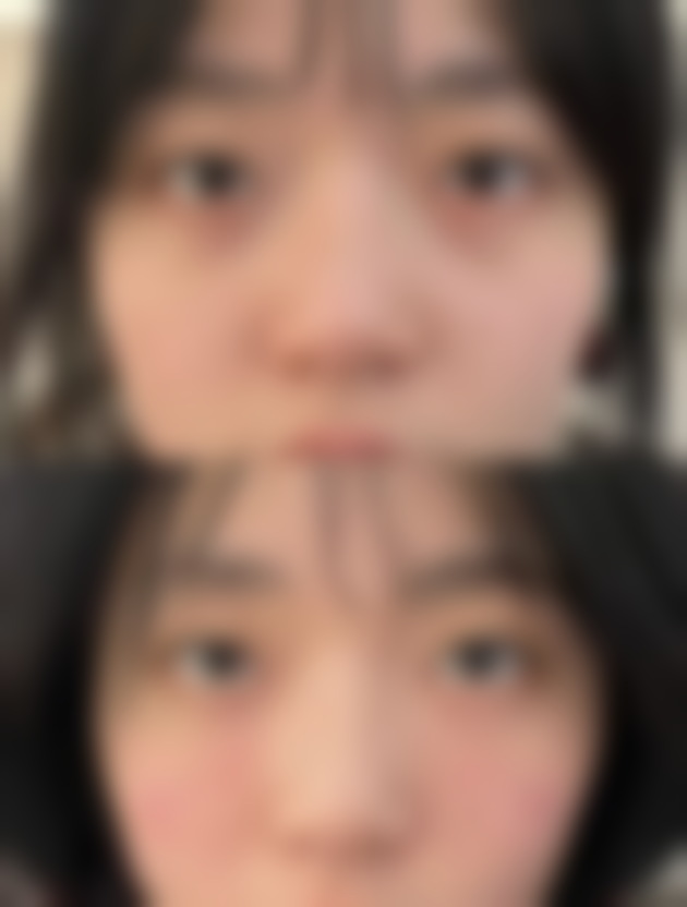 一、自体脂肪隆鼻维持时间的基本情况