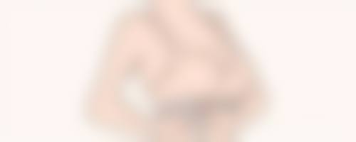 一、刚做完双眼皮手术眼睑外翻能否好转需综合判断