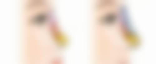 双眼皮手术有什么后遗症吗？常见风险如肿胀、不对称、增生等及应对办法揭秘 