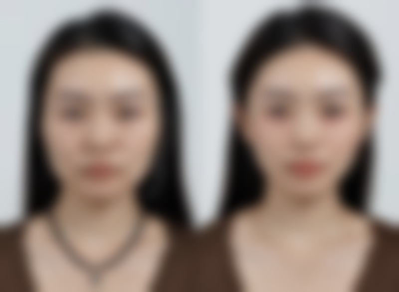 二、刚做完双眼皮手术眼睑外翻需警惕的医疗干预情况