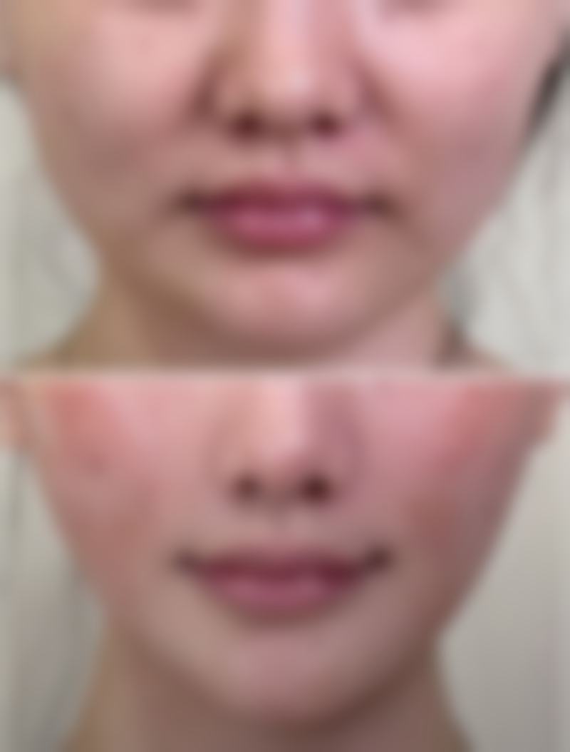 刚做完双眼皮手术眼睑外翻会好转吗？解析恢复情况与应对方案助你安心变美 