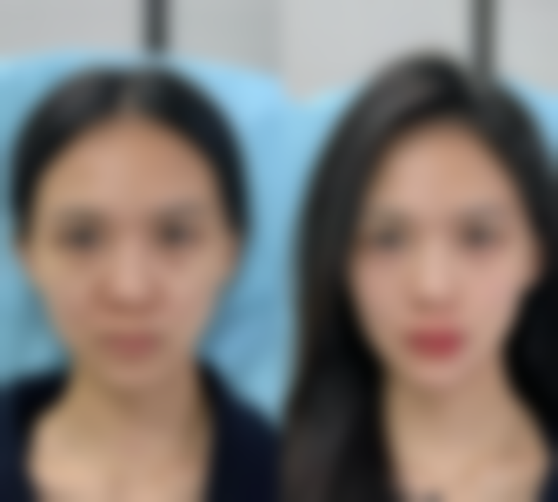 二、头发种植成效到底好不好之潜在不足与风险