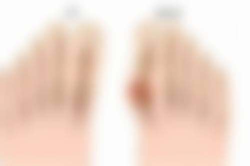 五、2年的疤痕增生治疗成效