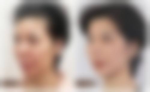 四、单眼皮塌鼻子的其他改善方法