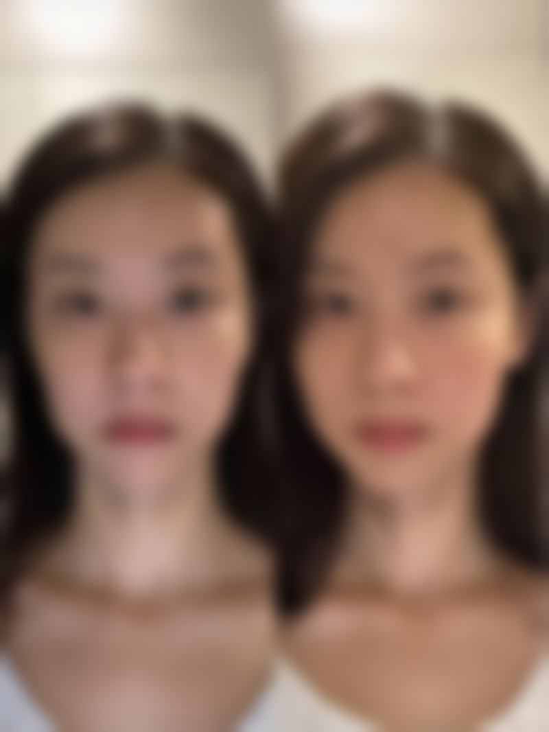 四、2年的疤痕增生治疗费用