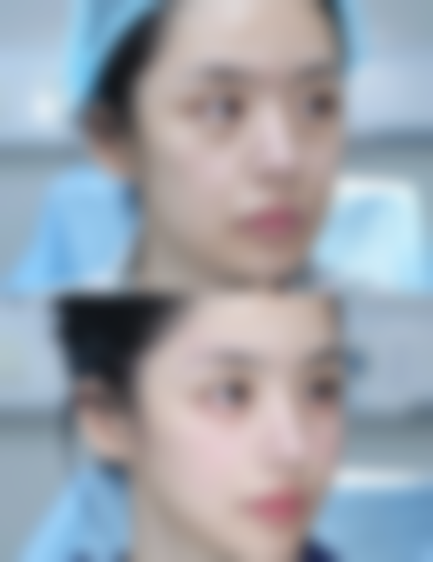 单眼皮隆鼻好看吗？女生通过隆鼻提升面部立体感与气质的真实案例揭秘 