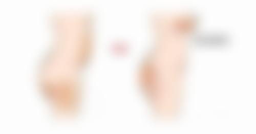 一、无痕去眼袋后下眼睑松弛的影响因素