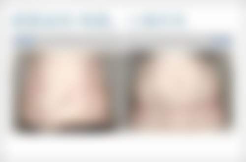 二、红色疤痕能否修复