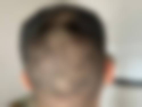 三、莱芜市人民医院整形烧伤科诊疗项目有哪些?