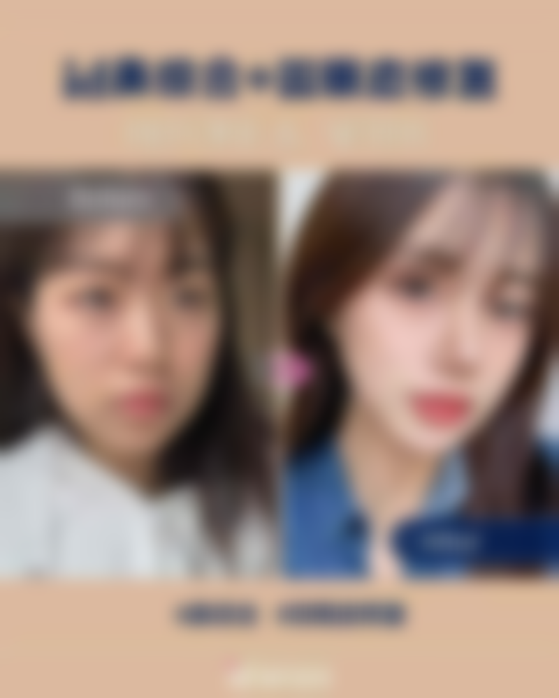 四、无痕双眼皮修复的美学设计要点