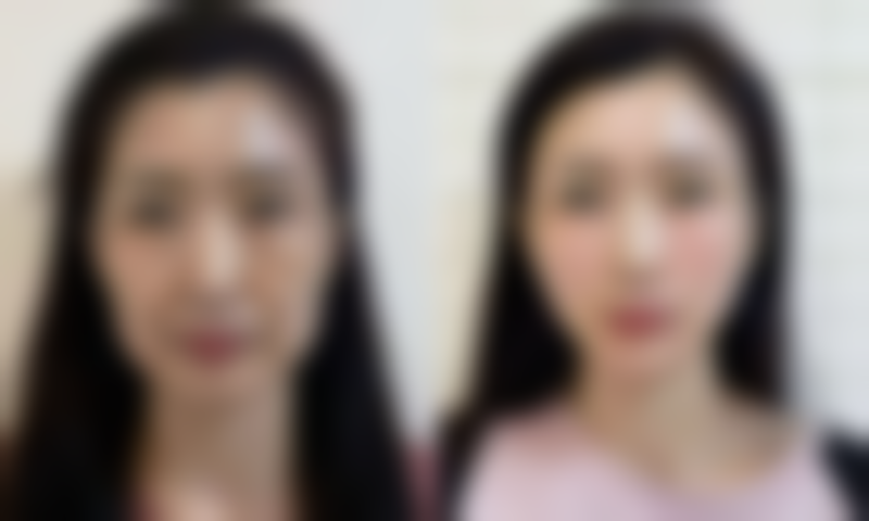 三、红色疤痕的修复方法