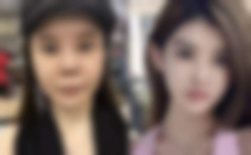 四、瘦脸针改善大小脸的成效预期