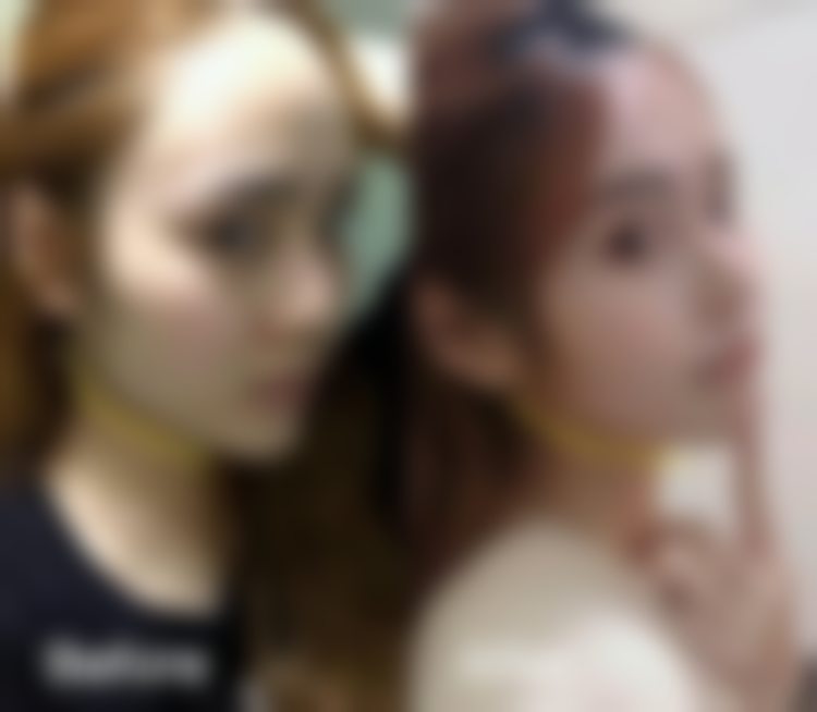 五、杭州连天美医院小阴唇缩小项目的实例见证