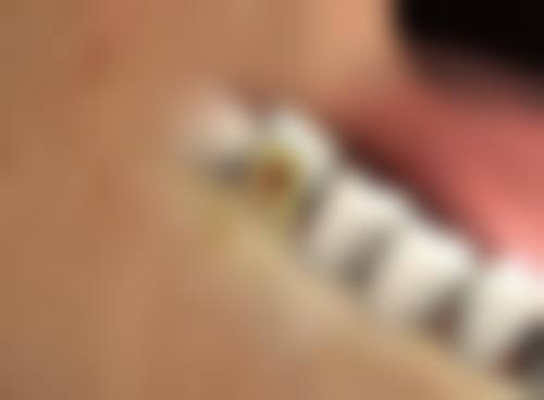 五、烧伤疤痕治疗的注意事项