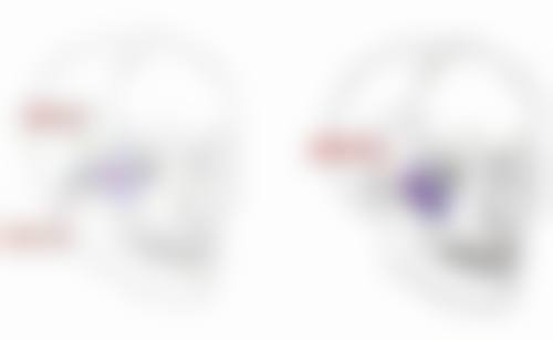 五、自体脂肪隆胸成效的具体实例分析